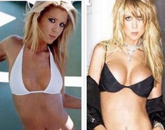 Διάσημες πριν και μετά την πλαστική στήθους (pics)