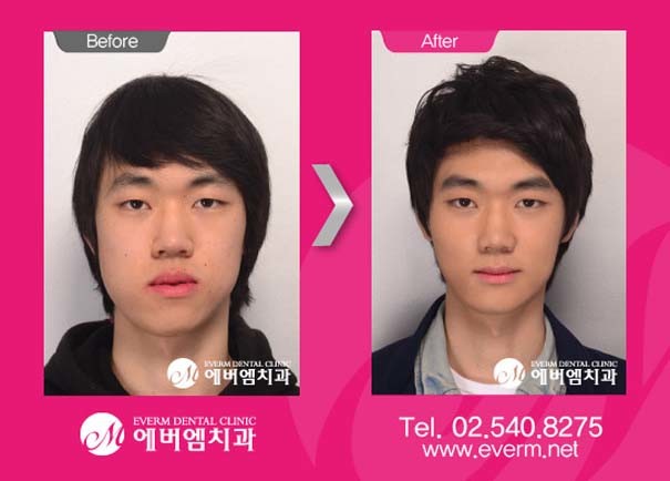Απίστευτες φωτογραφίες ανθρώπων πριν και μετά την πλαστική 