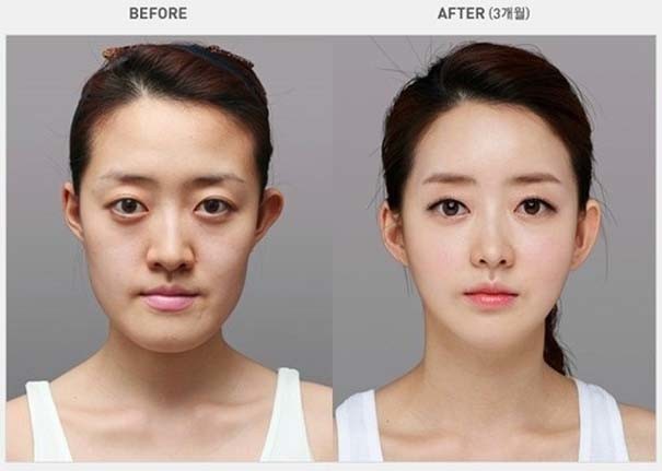 Απίστευτες φωτογραφίες ανθρώπων πριν και μετά την πλαστική 