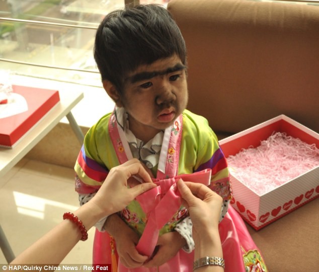 Το 4χρονο κοριτσάκι που πάσχει από το σύνδρομο του λυκανθρώπου (pics)