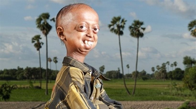 Η ιστορία ενός 14χρονου που ζει στο σώμα ανθρώπου 110 ετών (pics)