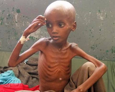 Σομαλία: 200.000 παιδιά κάτω των 5 ετών κινδυνεύουν από υποσιτισμό