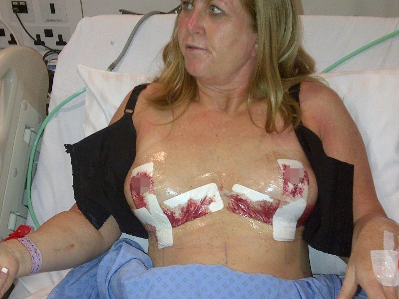 Βρετανία: Έσκασαν τα εμφυτεύματα σιλικόνης στο στήθος της! (photos)
