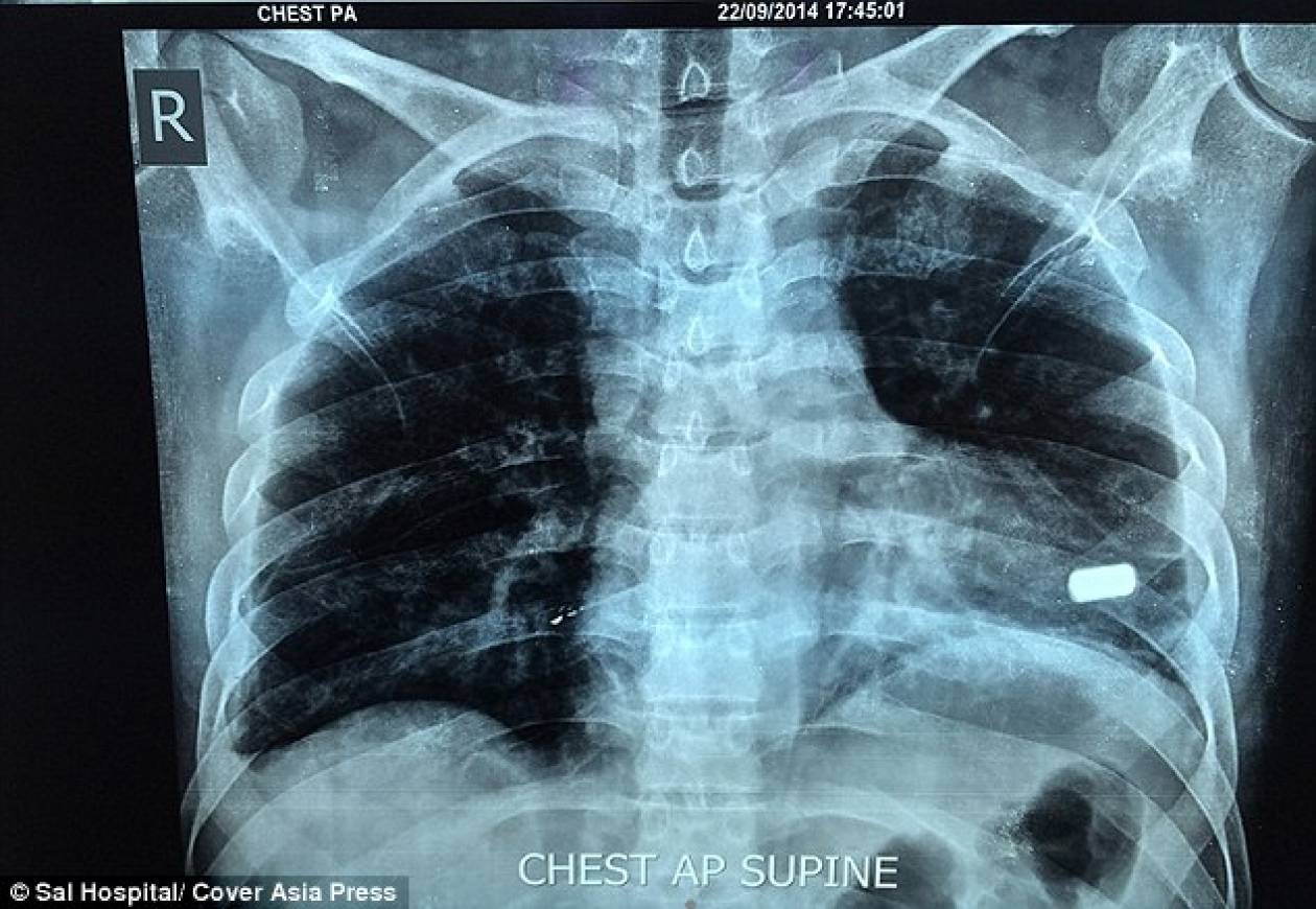 Огнестрельное ранение грудной клетки рентген