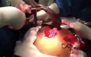 Βραζιλία: Έβγαλαν από το στομάχι ασθενή ένα... ψάρι (σκληρό βίντεο)