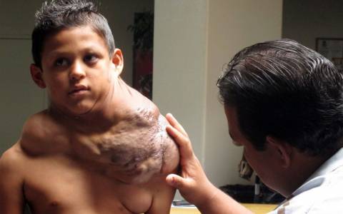 Νέο Μεξικό: Αφαίρεσαν τεράστιο όγκο από 11χρονο