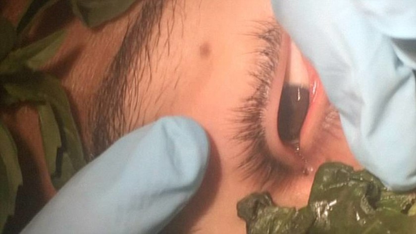 Οι γιατροί δεν μπορούσαν να φανταστούν τι έκρυβε στο μάτι του… για ένα μήνα (video&photos)