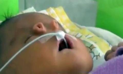 Μωρό γεννήθηκε με δύο «σωληνάκια» αντί για μύτη (video)