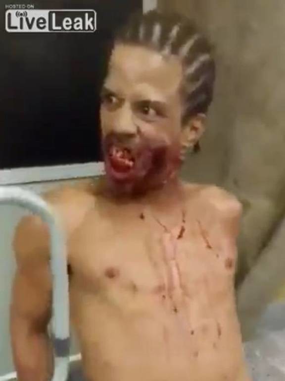 Βίντεο: «Δαιμονισμένος» με σφαίρα στο κεφάλι περπατά σαν ζόμπι και τρομοκρατεί νοσοκομείο!