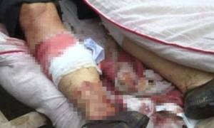 Φρικιαστικό δυστύχημα: Έκοψε κατά λάθος τα πόδια της γυναίκας του με το χορτοκοπτικό (pics)