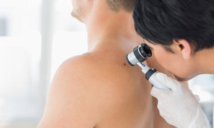 Μελάνωμα: Δωρεάν έλεγχοι για την πρόληψη του καρκίνου του δέρματος
