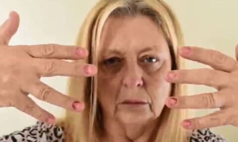 Εφιάλτης για 53χρονη: Της πέφτουν όλα τα νύχια ξανά και ξανά λόγω μυστηριώδους πάθησης