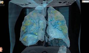 Κορονοϊός: Σοκαριστικό video αποκαλύπτει τις βλάβες που προκαλεί ο ιός στους πνεύμονες