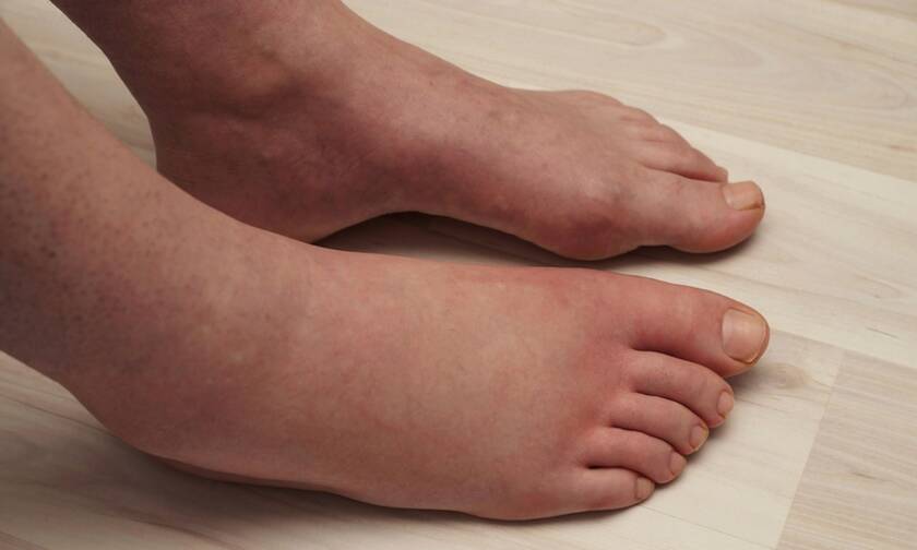 Πρησμένα πόδια: 5 πιθανές αιτίες που πρέπει να γνωρίζετε (pics)