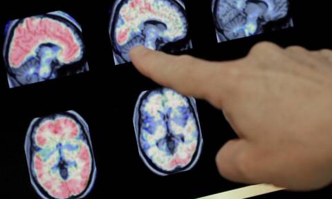 Ανησυχία για πιθανή νέα ασθένεια στον Καναδά: «Αίνιγμα» με μυστηριώδη εγκεφαλική διαταραχή