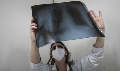 Κορονοϊός: Η εντυπωσιακή φωτογραφία του Ζούκερμπεργκ με ακτινογραφία θώρακος ασθενούς με covid