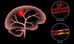 Εγκεφαλικό: Ο αδιάγνωστος παράγοντας κινδύνου που αφορά το 67% των ασθενών