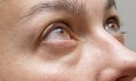 Διαβήτης: Το σημάδι στα μάτια που δείχνει διαβητική νεφροπάθεια