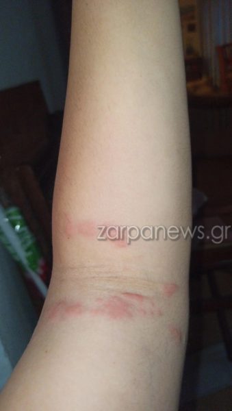 Μωβ μέδουσες: Διπλή επίθεση σε γυναίκα που έκανε μπάνιο στα Χανιά - Τα συμπτώματα ΦΩΤΟ