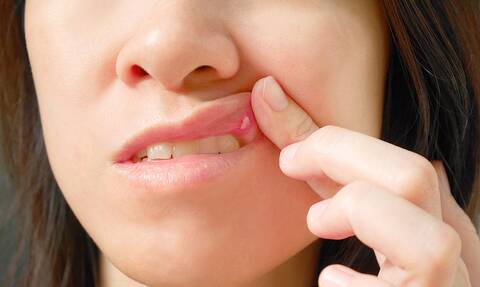 Ανεπάρκεια βιταμίνης Β12: Οι αλλαγές στο στόμα που πρέπει να σας θορυβήσουν