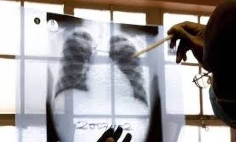 Φυματίωση: Τρομάζουν τα στοιχεία - Ανησυχία στην παγκόσμια κοινότητα