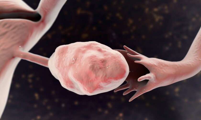 Προστατεύει η σαλπιγγεκτομή από τον καρκίνο των ωοθηκών;